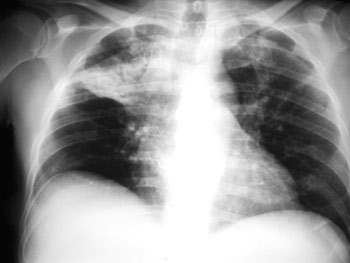 Resultado de imagen para radiografía tuberculosis